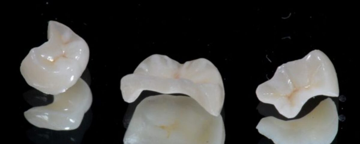 Restauração porcelana inlay