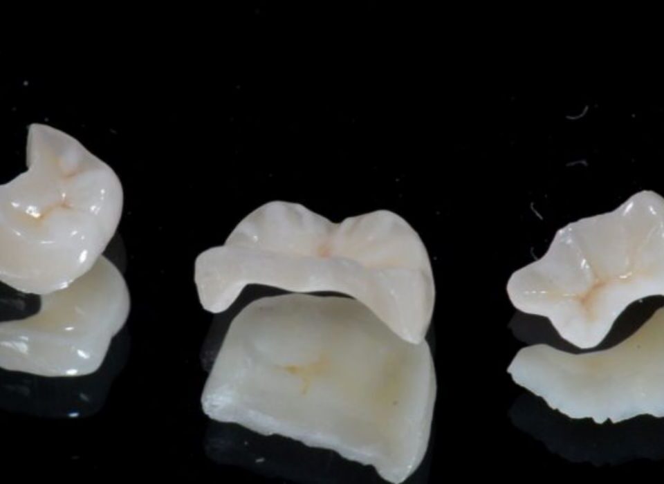 Restauração porcelana inlay