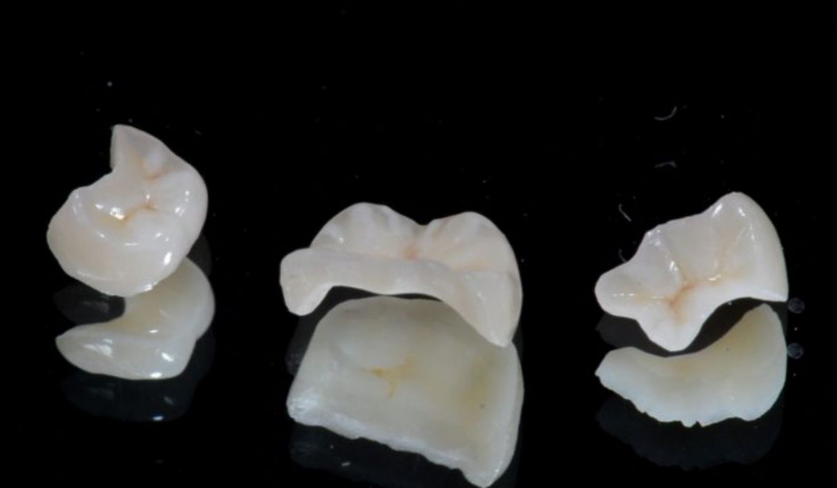 Restauração porcelana inlay