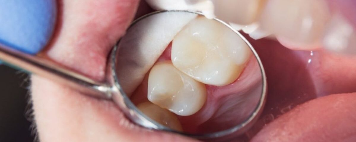 Restauração resina dentista Curitiba