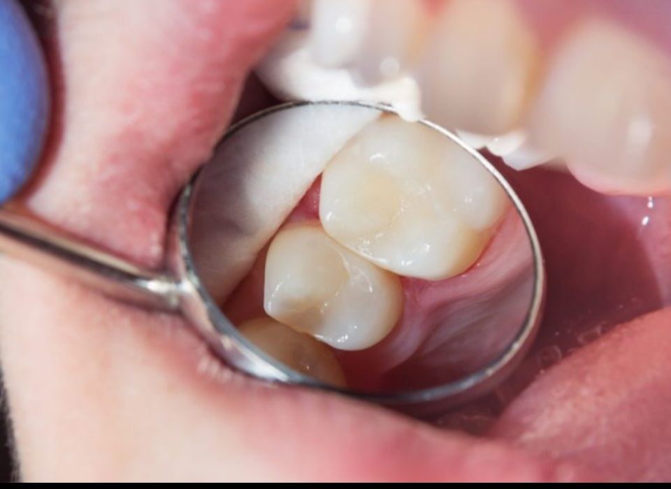 Restauração resina dentista Curitiba