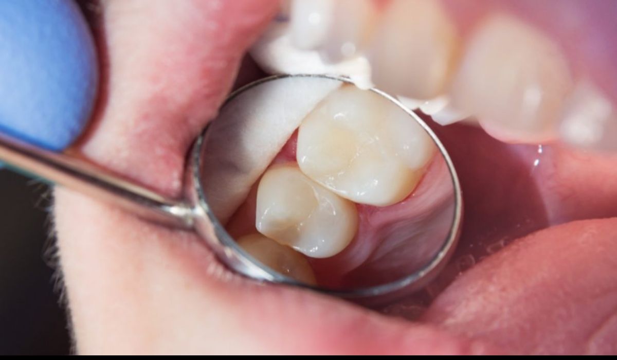 Restauração resina dentista Curitiba
